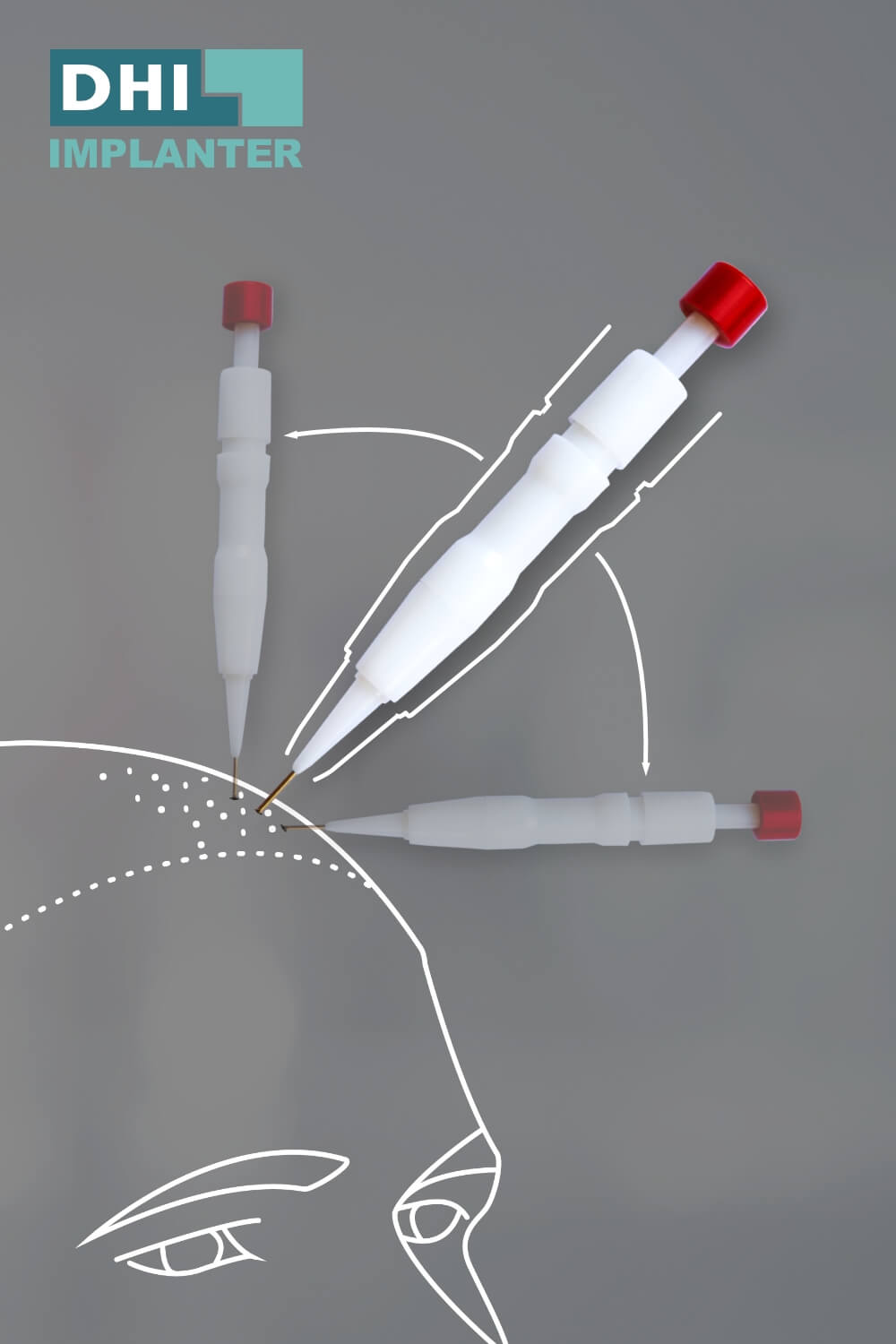 Bild zeigt Implanter