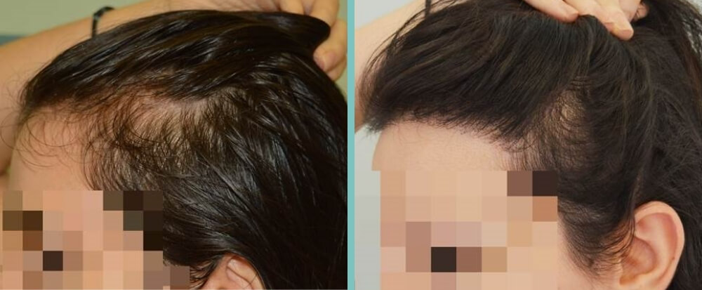 Vorher Nachher – Hanna P.