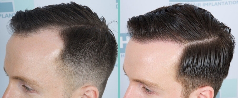 Vorher Nachher – Ben T.