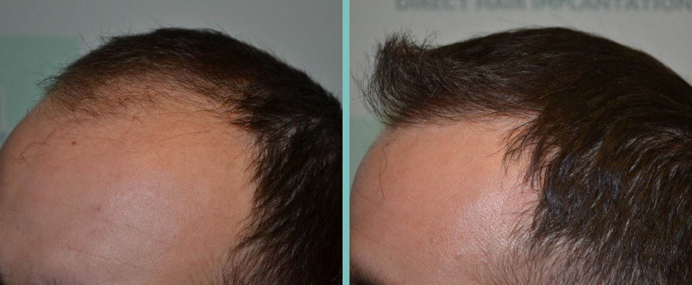 Vorher Nachher – Bora S.