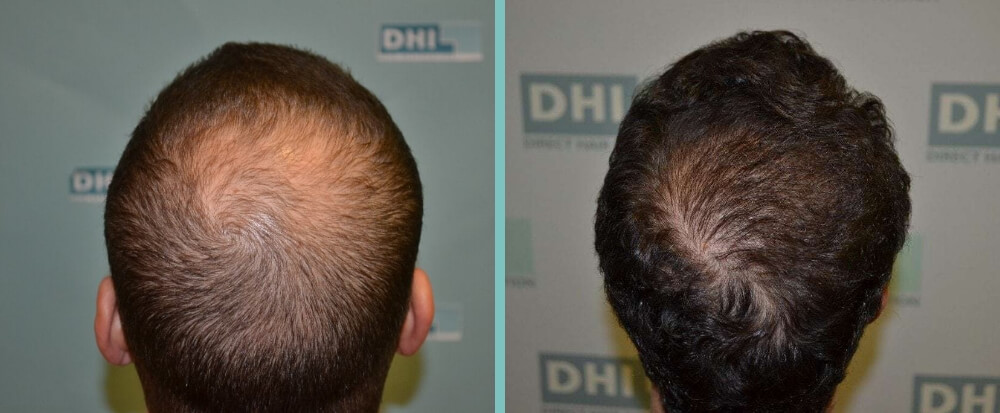 Vorher Nachher – Carlos T.