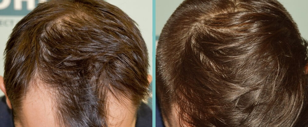 Vorher Nachher – Elias G.