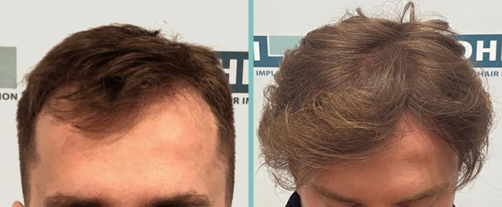 Vorher Nachher – Felix R.