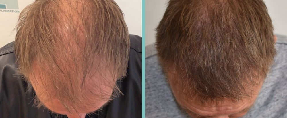 Vorher Nachher – Hermann B.