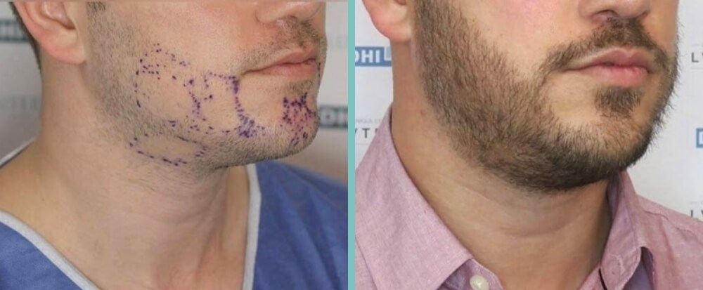 Vorher Nachher – Jonas Z.