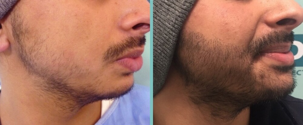 Vorher Nachher – Malik S.