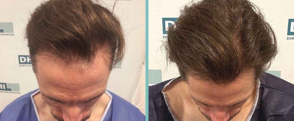 Vorher Nachher – Manuel W.