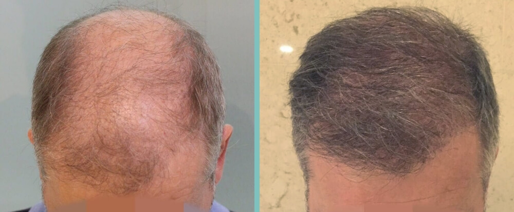 Vorher Nachher – Martin M.