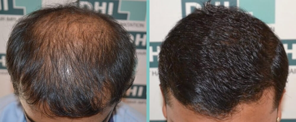 Vorher Nachher – Matteo S.