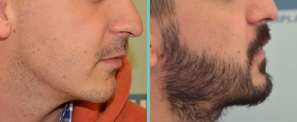 Vorher Nachher – Mesut P.