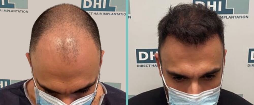 Vorher Nachher – Murat T.