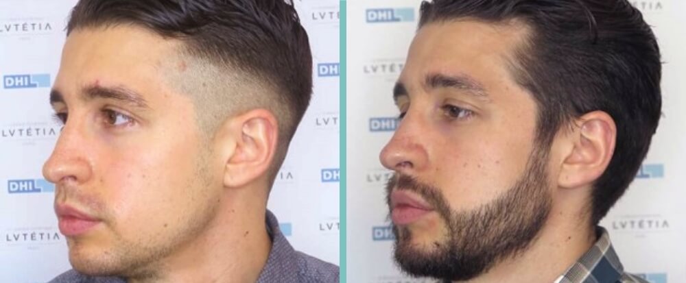 Vorher Nachher – Mustafa N.