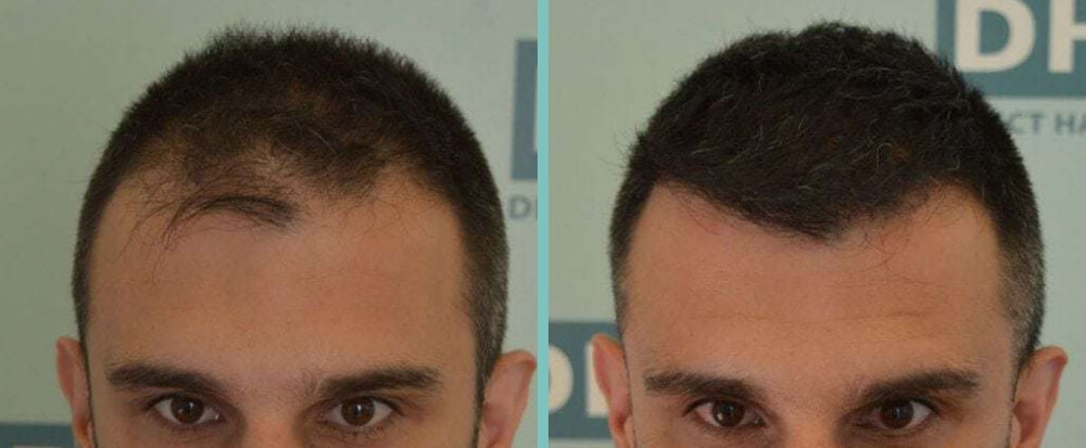 Vorher Nachher – Robert T.