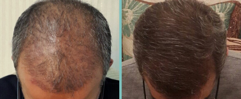 Vorher Nachher – Roman H.