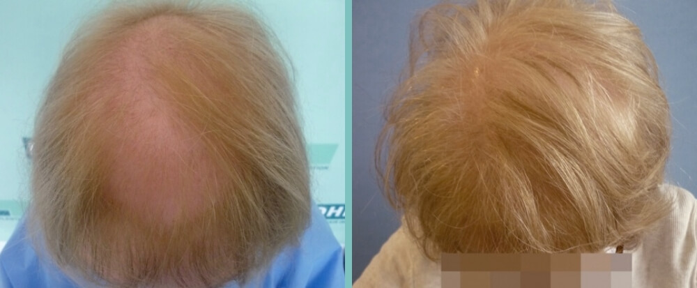 Vorher Nachher – Samantha H.