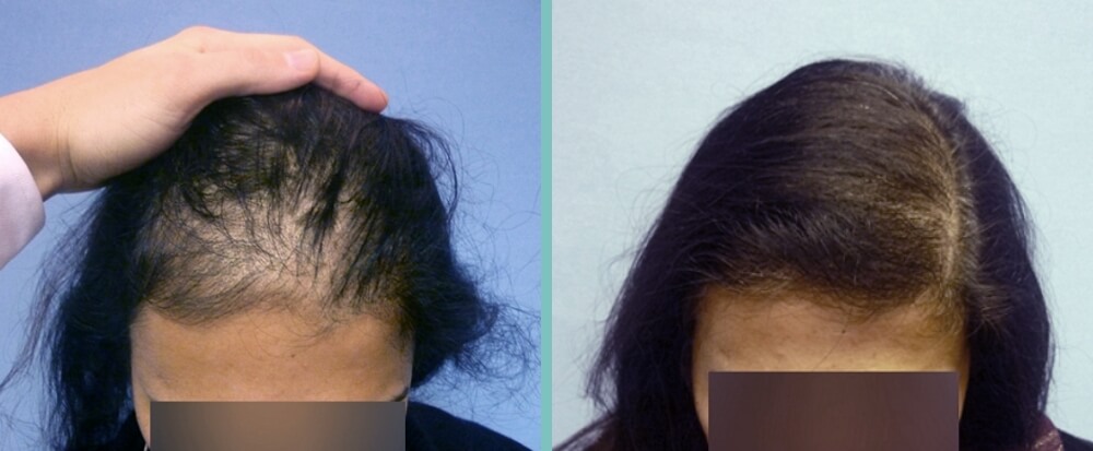 Vorher Nachher – Sandra P.