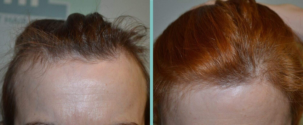 Vorher Nachher – Simona L.