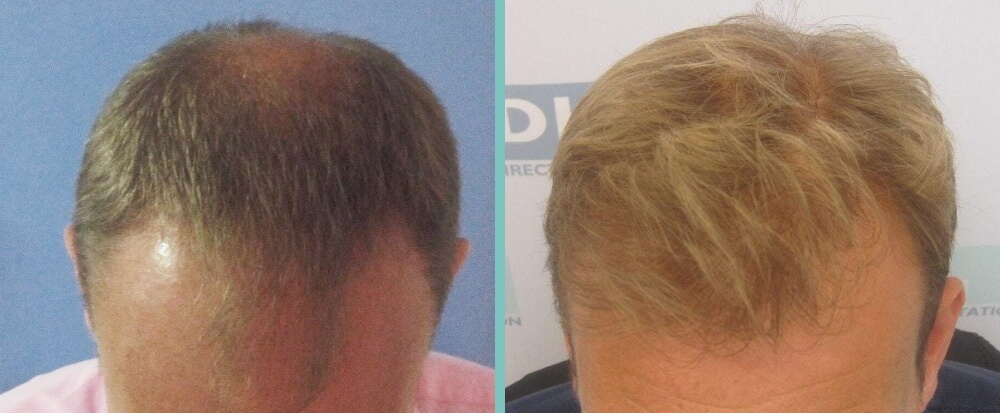 Vorher Nachher – Sven N.