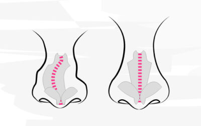 Die Königsdisziplin der Schönheitsoperationen – die Nasenkorrektur!