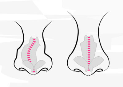 Die Königsdisziplin der Schönheitsoperationen – die Nasenkorrektur!