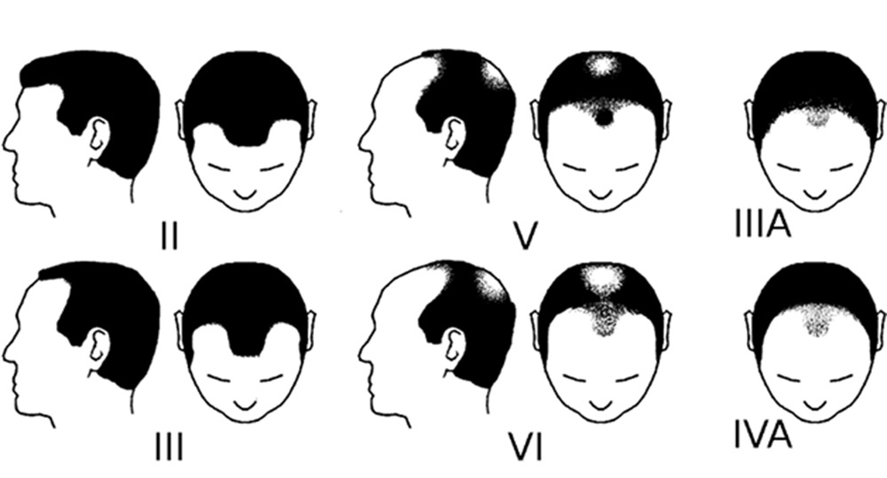 Die Stufen des Haarausfalls