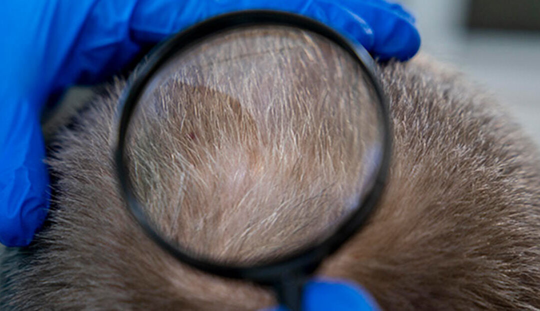 Meilensteine der Haartransplantation
