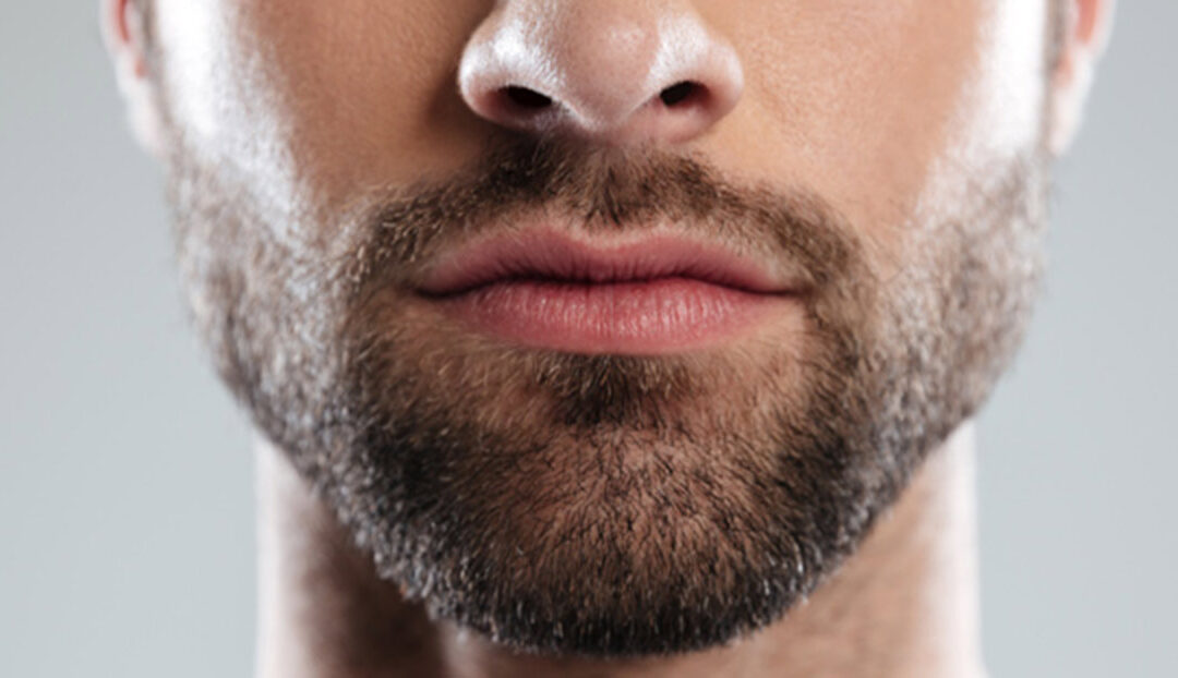 Barttransplantation in Wien: für einen vollen, dichten Bart