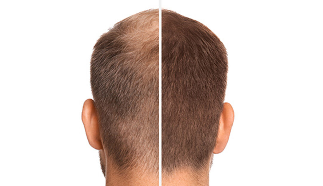 Meilensteine der Haartransplantation