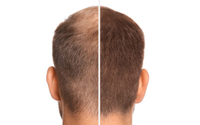 Meilensteine der Haartransplantation