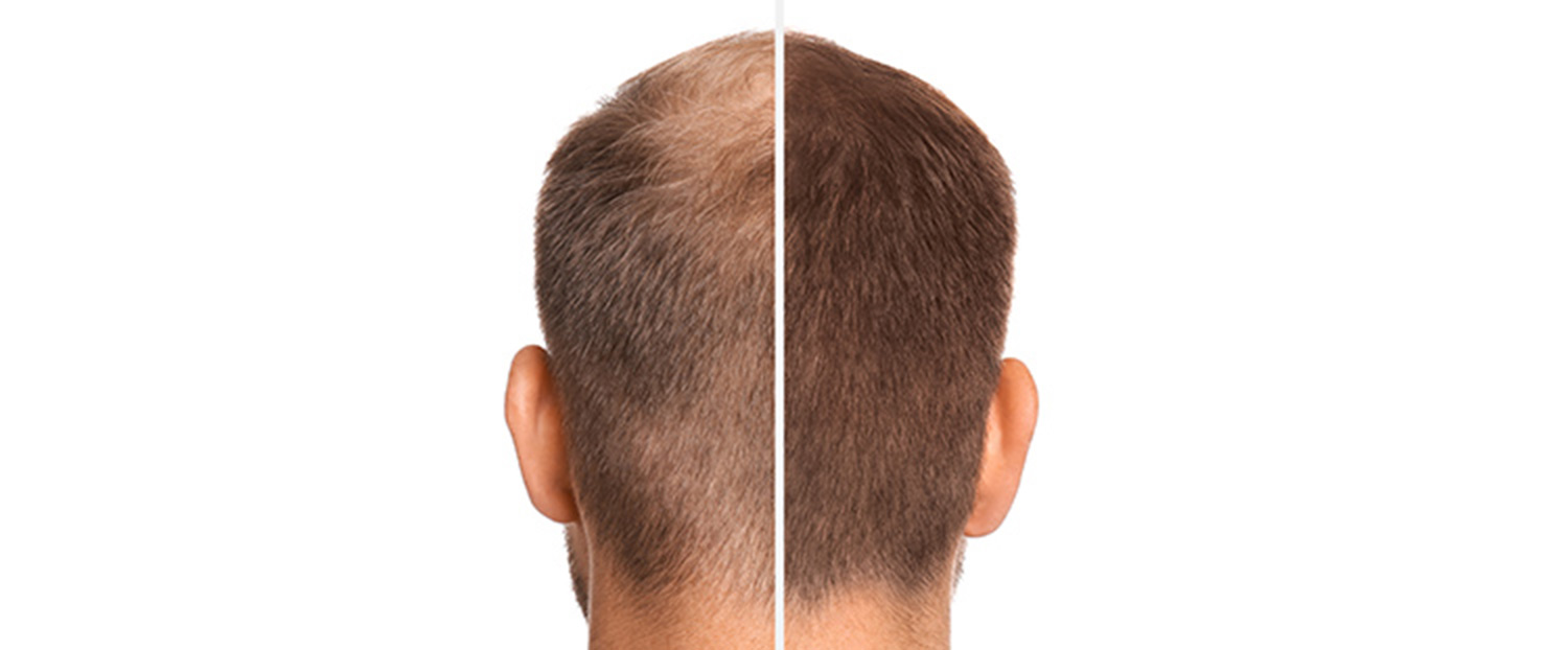 man-with-hair-loss-problem-before-after Bild zeigt Mann vor und nach Haartransplantation