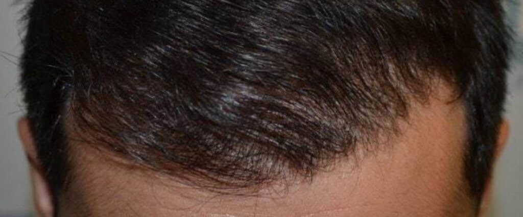 Haartransplantation in Österreich: Die Vorteile im Überblick