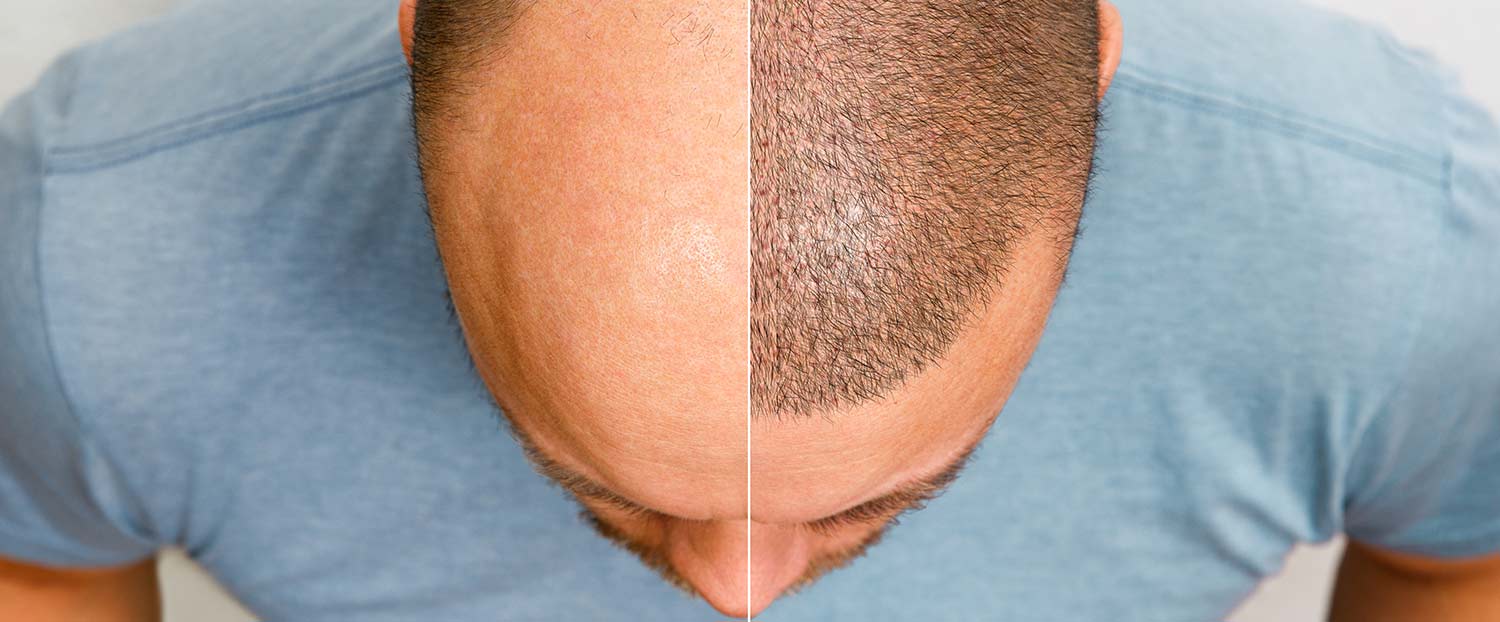 haarverpflanzung Bild zeigt Haarverpflanzung