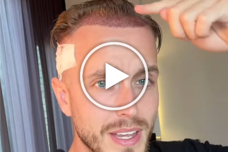 vorschaubild-video-testimonial-2 Bild zeigt Mann nach Haartransplantation