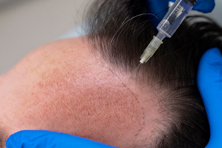 eingezeichneter Haaransatz