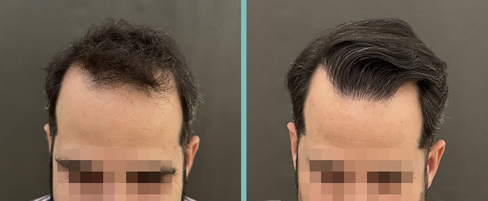 Vorher Nachher – Leon F.