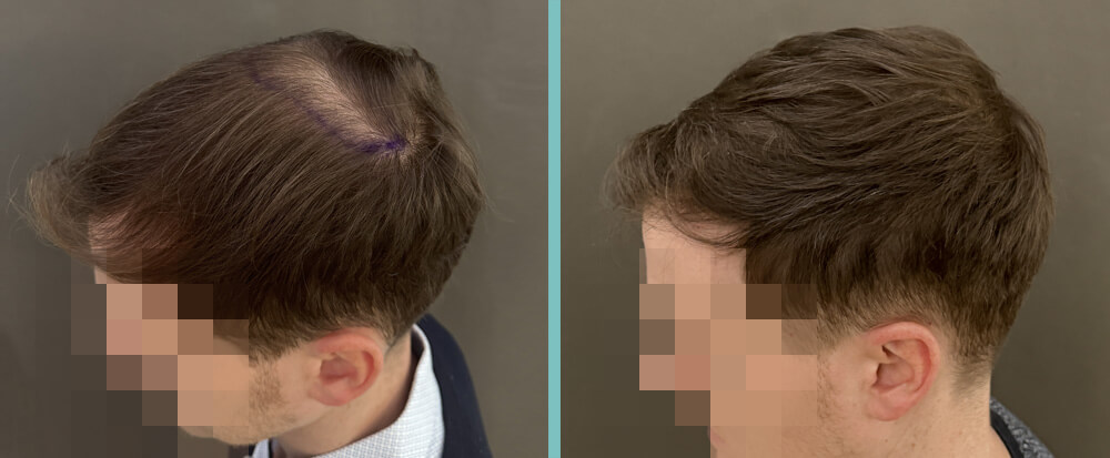 Vorher Nachher – Dominik F.