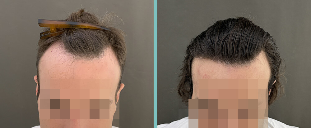 Haartransplantation vorher nachher
