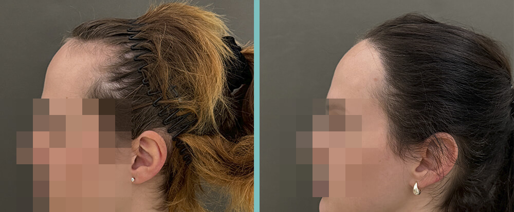 Haartransplantation Frau vorher / nachher