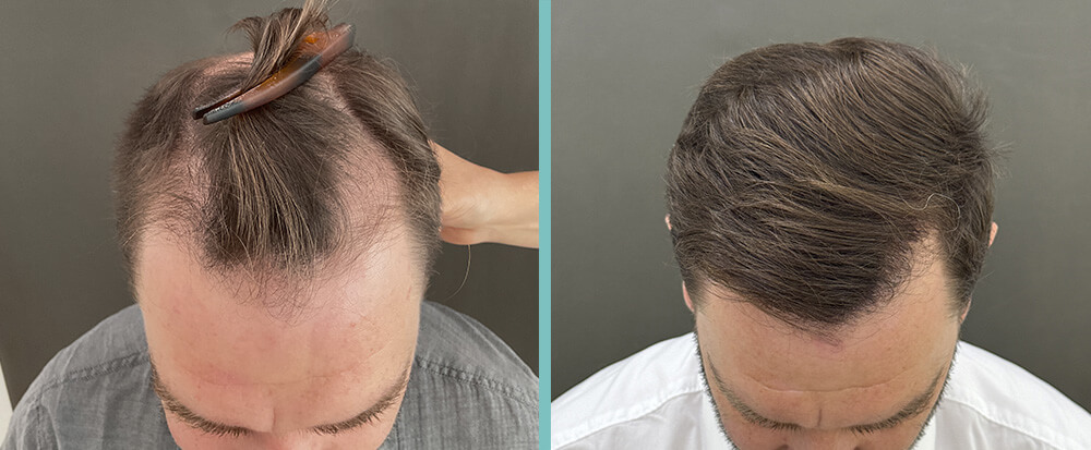 Vorher Nachher – Markus H.