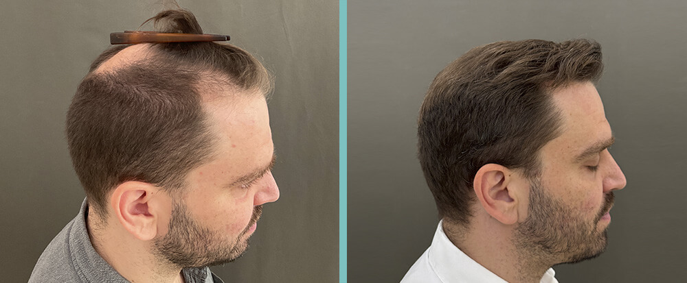 vorher nachher Haartransplantation