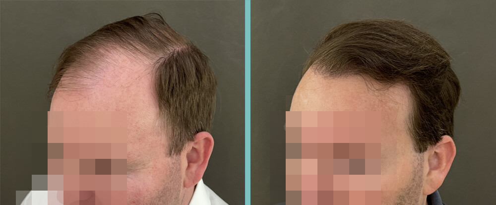 Vorher Nachher – Maximilian H.