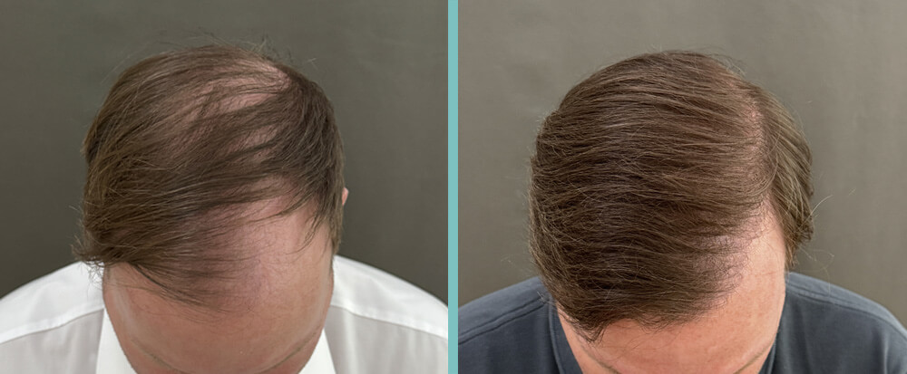 Vergleich vorher nachher Haartransplantation