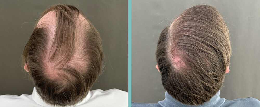 Vergleich vorher nachher Haartransplantation