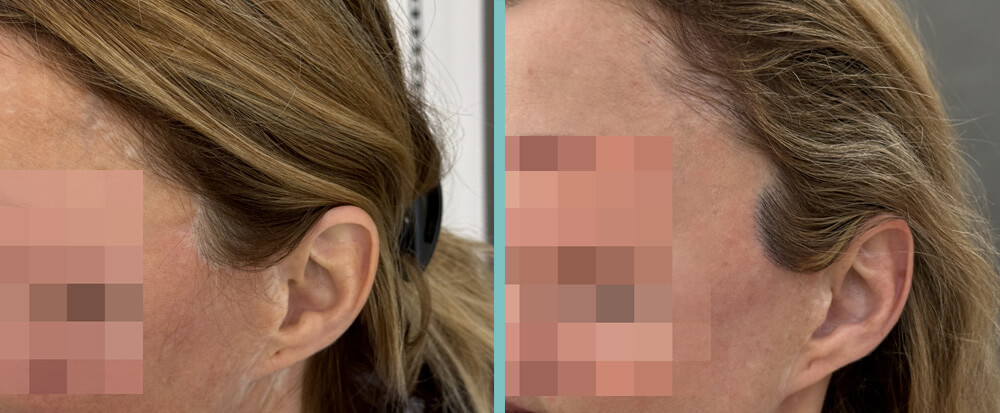 Vorher Nachher – Theresa L.