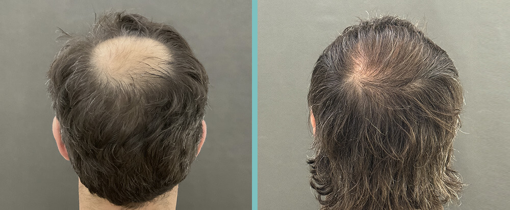 Vorher Nachher – Wolfgang K.