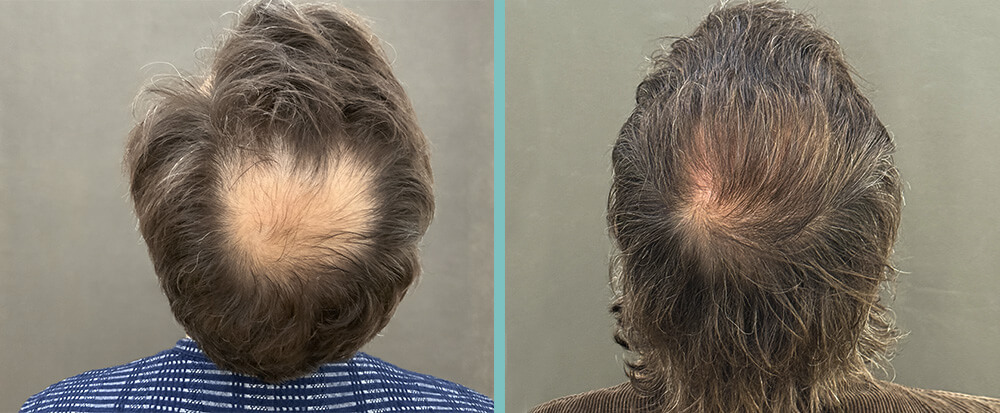 Haartransplantation Tonsur vorher nachher