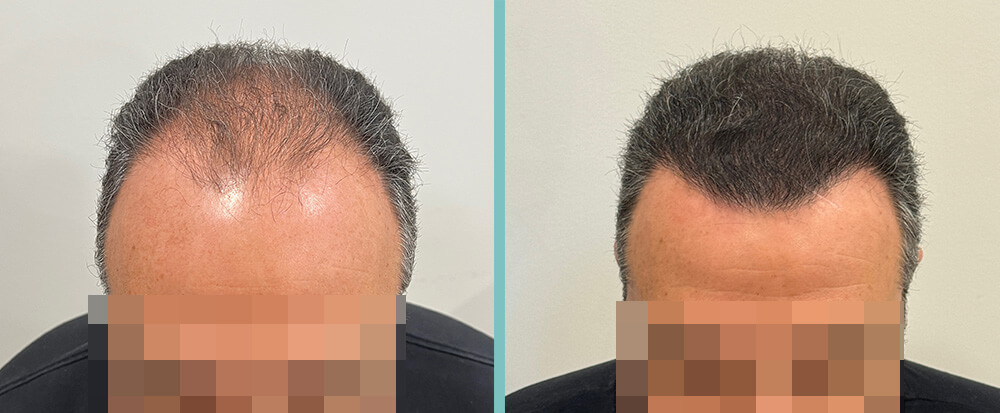 Vorher Nachher – Dario M.