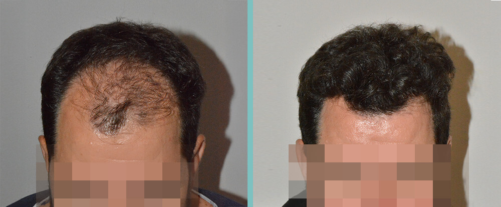 Vorher Nachher – Romano A.