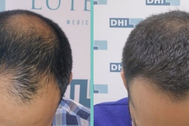 vorher nachher in Fülle